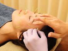 段上はり灸整骨院/お顔も気分も上がる美容鍼灸♪