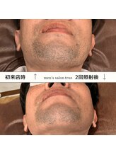 トゥルー(true)/ヒゲ脱毛 2回照射