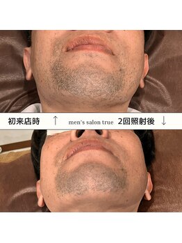 トゥルー(true)/ヒゲ脱毛 2回照射