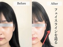 アライメント 自由が丘(Alignment)/施術例（小顔矯正）