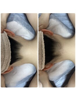 ルルトウキョウ 池袋店(LULU.tokyo)/うなじ脱毛