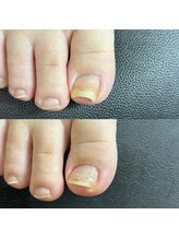 リリ(lili)/巻き爪矯正1回目（右親指）