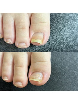 リリ(lili)/巻き爪矯正1回目(右親指)