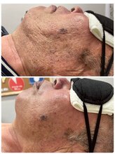 エアリアル 玉名店/ヒゲ脱毛