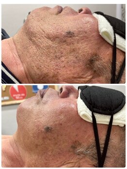 エアリアル 玉名店/ヒゲ脱毛