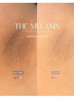 クレラ バイ コリアンビューティー 新大久保店(CLERA by Korean Beauty)/肘│THE MELANIN│ザメラニン