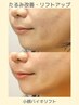 【理想のフェイスラインに!】筋膜から引き上げる小顔バイオリフト