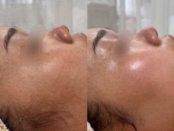 ソルシエール/レディースシェービング