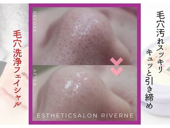 リヴェーヌ 富山店の写真/【様々な毛穴悩みに対応☆小鼻もつるんつるん】毛穴ケアの新定番！とるだけじゃなく引き締める！