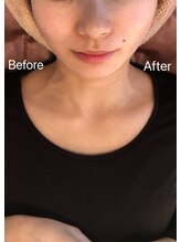リフト 門前仲町(Lift)/小顔専門店Lift｜Before After
