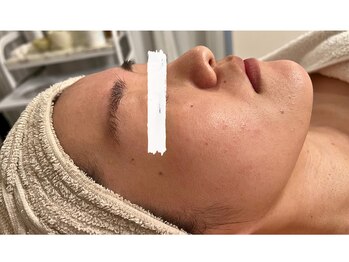 モネ(monet)/コメド・赤み出やすい方へ