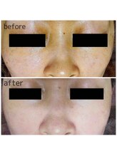 ブランシェ 野々市店 × 椿/シミケア　お客様