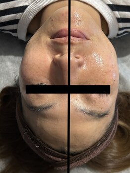 アケルビューティースタジオ(acer beautystudio)/Eライト小顔フェイシャル