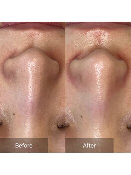 リツイート(ReTweet)/ララピール・艶肌・美白・くすみ