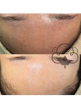 プライベートサロン コットン(COTTON)/毛穴エクストラクション