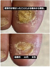 巻き爪じゅん 船橋店/痛み原因は肥厚爪の刺さり