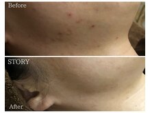 ストーリー(STORY)/ハーブピーリング専門店STORY