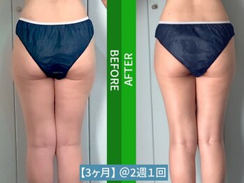 ジョワインフィニ 外苑前(JOIE INFINIE)/【ビフォーアフター】インディバ