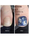 巻き爪改善＋デザインネイル