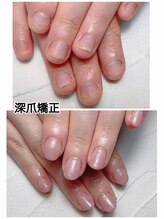 スマイルニコ(smile nico)/オフィスネイルで深爪矯正