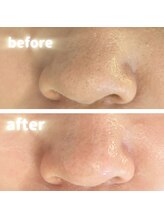 ホワイト ターコイズ/鼻と頬の毛穴＆黒ずみは専門店で