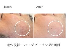 ミレア(Mire-A)/おひげの処理後のケアに♪