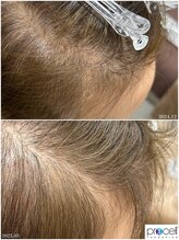 ヒルナム(Heal Nam)/~プロセルセラピーズ~頭皮