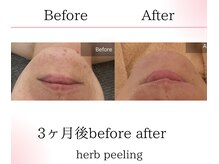 サロンツキ(salon tuki)/ハーブピーリング症例/徳島