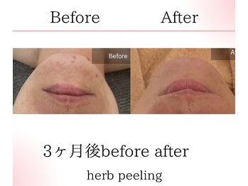 サロンツキ(salon tuki)/ハーブピーリング症例/徳島