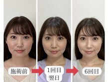 顔凛(カオリン)/30代女性の小顔矯正