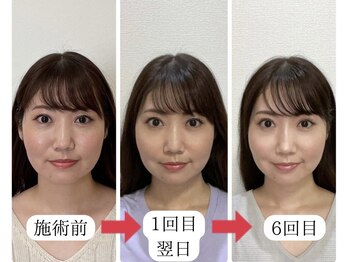 顔凛(カオリン)/30代女性の小顔矯正