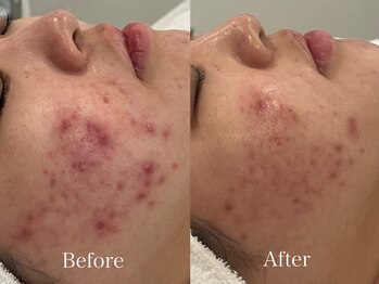 リフコウベ(LIF KOBE)/赤いニキビ：コモデックス1回