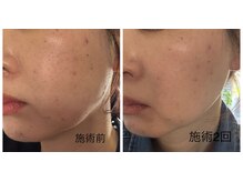 アジュール(azure)/毛穴の変化！