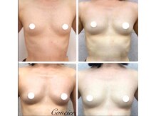 美人バスト 本厚木店/バストアップ◇症例◇
