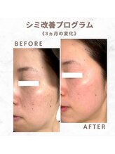 サロンソワ(salon Soi.)/ピュールボーテ：シミ改善