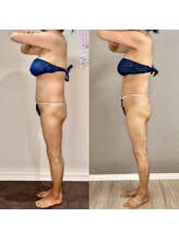 カルナ(CARNA)/【痩身】セルライトゼロ2