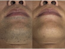 フェリス(FELIZ)/メンズ人気No.1 ヒゲ脱毛