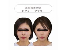 ワンモア 新町店(1MORE)の雰囲気（むくみ顔専門５回でモデル級小顔に！唯一無二やせ見え小顔矯正）