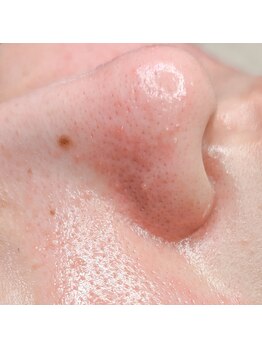 サロン サルタス(salon Saltus)/毛穴after