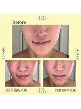 シェリエ(CHERIE)/エクソリフト