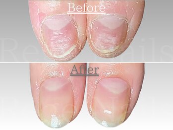 自爪育成・深爪改善コース