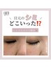 新メニュー【シミケア放題30分】ダウンタイムあり◎(1週間程度)初回のみ¥5500