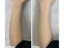 ベルフィオーレ(bel fiore)/メンズ脱毛　腕