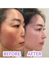 ケイビューティ(k-beauty)/速小顔コルギ/水玉リフティング