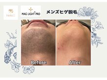 抜ける脱毛◎全身一人一人に合わせた施術で痛みが少なく結果重視