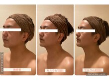 小顔コルギ専門店 フェルーシュ 成田駅前店(Feruche)/20代男性　結果写真