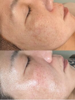 デコアイ(Deco eye)/50代女性 下垂毛穴改善