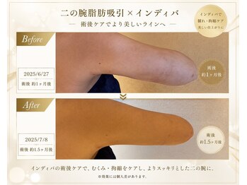 マドモアゼルメゾン 恵比寿(マドモアゼルMaison)の写真/【二の腕脂肪/吸引後に◎】腫れ・むくみ・拘/縮をインディバでケア♪すっきり華奢な二の腕へ