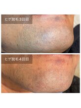 ブリッシュ(Bullish)/ヒゲ脱毛4回目照射後の途中経過