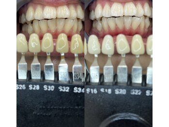 トウキョウスワーズ 池袋店(TOKYO SWRS)/#ホワイトニング #池袋 #渋谷